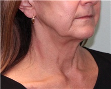 Facelift Before Photo by Jennifer Greer, MD; Mentor, OH - Case 41135