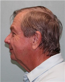 Facelift Before Photo by Jennifer Greer, MD; Mentor, OH - Case 41330