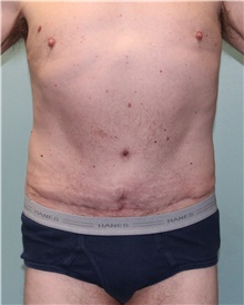 Tummy Tuck After Photo by Jennifer Greer, MD; Mentor, OH - Case 41331