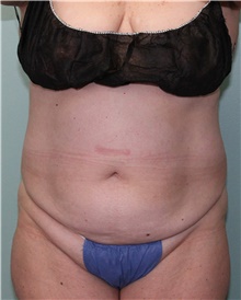 Nonsurgical Fat Reduction Before Photo by Jennifer Greer, MD; Mentor, OH - Case 41332