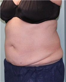 Nonsurgical Fat Reduction After Photo by Jennifer Greer, MD; Mentor, OH - Case 41332