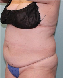 Nonsurgical Fat Reduction Before Photo by Jennifer Greer, MD; Mentor, OH - Case 41332