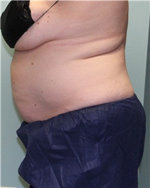Nonsurgical Fat Reduction After Photo by Jennifer Greer, MD; Mentor, OH - Case 41333