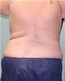 Nonsurgical Fat Reduction After Photo by Jennifer Greer, MD; Mentor, OH - Case 41333