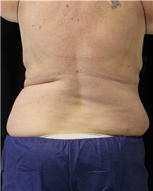Nonsurgical Fat Reduction Before Photo by Jennifer Greer, MD; Mentor, OH - Case 41333
