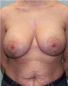 Breast Lift After Photo by Jennifer Greer, MD; Mentor, OH - Case 41655