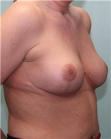 Breast Reduction After Photo by Jennifer Greer, MD; Mentor, OH - Case 41656