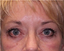 Eyelid Surgery After Photo by Jennifer Greer, MD; Mentor, OH - Case 41658
