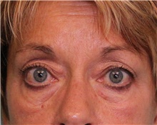Eyelid Surgery Before Photo by Jennifer Greer, MD; Mentor, OH - Case 41658
