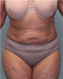 Liposuction After Photo by Jennifer Greer, MD; Mentor, OH - Case 41659