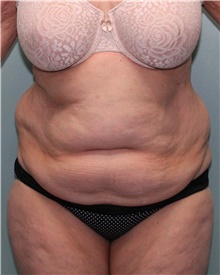 Liposuction Before Photo by Jennifer Greer, MD; Mentor, OH - Case 41659