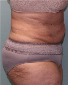 Liposuction After Photo by Jennifer Greer, MD; Mentor, OH - Case 41659
