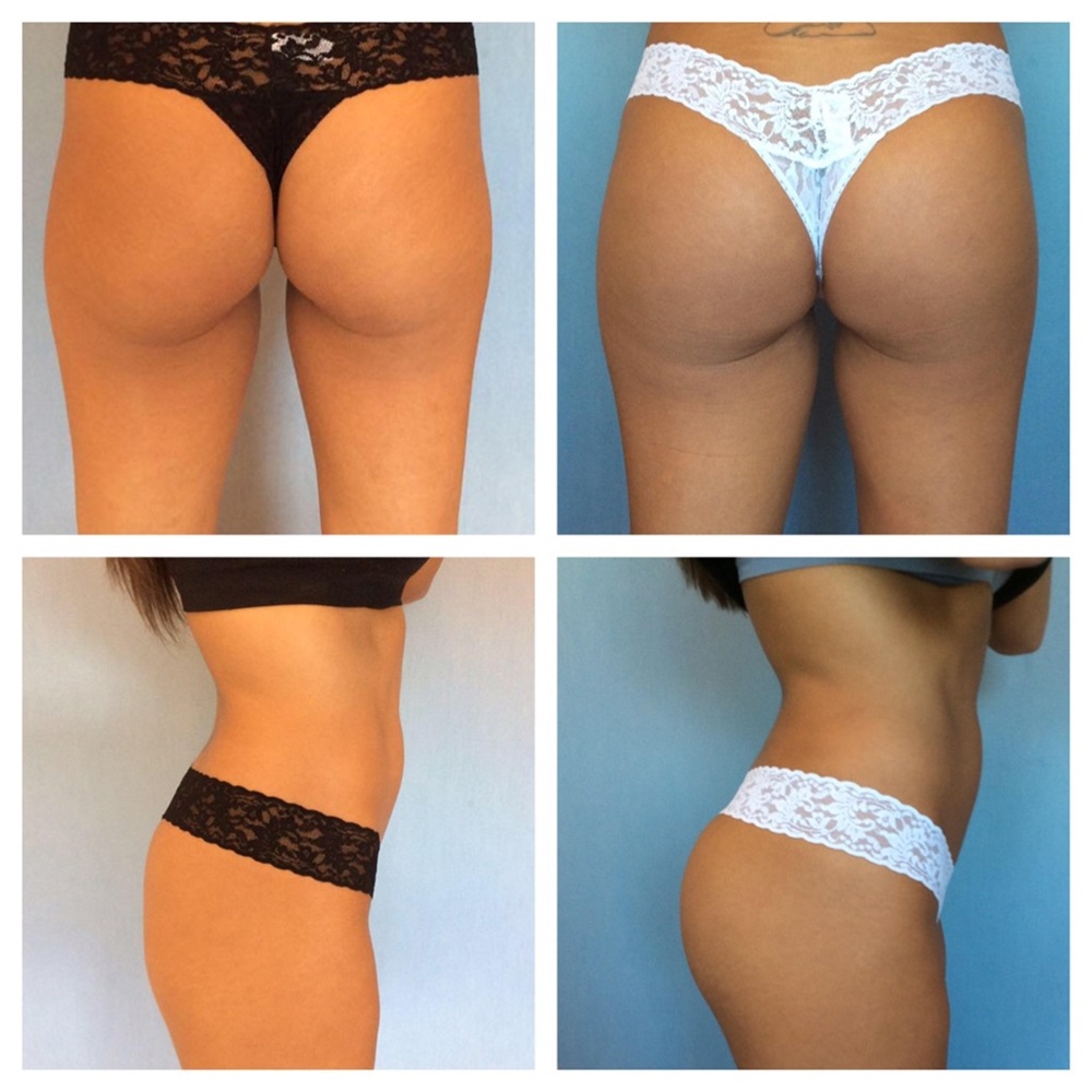 Buttock Implants Before and After Photos by Anthony Admire, MD