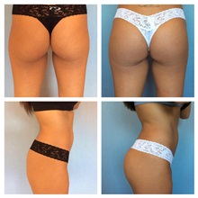 Buttock Implants Before Photo by Anthony Admire, MD; Scottsdale, AZ - Case 30213