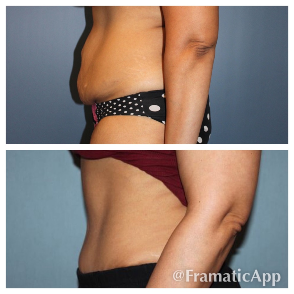 Non-Invasive Abdominal Liposuction in Scottsdale AZ
