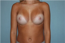 Breast Augmentation After Photo by Anthony Admire, MD; Scottsdale, AZ - Case 30607