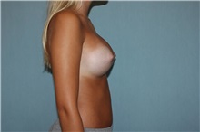 Breast Augmentation After Photo by Anthony Admire, MD; Scottsdale, AZ - Case 30607