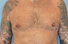 Male Breast Reduction After Photo by Anthony Admire, MD; Scottsdale, AZ - Case 30608