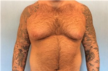 Male Breast Reduction Before Photo by Anthony Admire, MD; Scottsdale, AZ - Case 30608