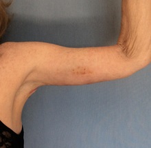 Arm Lift After Photo by Anthony Admire, MD; Scottsdale, AZ - Case 30609