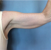 Arm Lift Before Photo by Anthony Admire, MD; Scottsdale, AZ - Case 30609