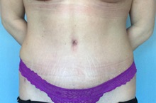 Tummy Tuck After Photo by Anthony Admire, MD; Scottsdale, AZ - Case 30610