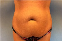 Tummy Tuck Before Photo by Anthony Admire, MD; Scottsdale, AZ - Case 30610