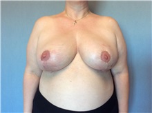 Breast Reduction After Photo by Anthony Admire, MD; Scottsdale, AZ - Case 30618