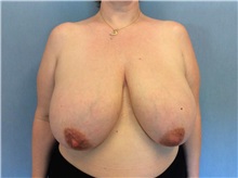 Breast Reduction Before Photo by Anthony Admire, MD; Scottsdale, AZ - Case 30618