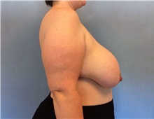 Breast Reduction Before Photo by Anthony Admire, MD; Scottsdale, AZ - Case 30618