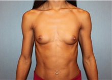 Breast Augmentation Before Photo by Anthony Admire, MD; Scottsdale, AZ - Case 30619