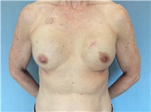 Breast Reconstruction After Photo by Anthony Admire, MD; Scottsdale, AZ - Case 30620