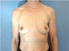 Breast Reconstruction Before Photo by Anthony Admire, MD; Scottsdale, AZ - Case 30620