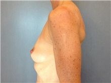 Breast Reconstruction Before Photo by Anthony Admire, MD; Scottsdale, AZ - Case 30620