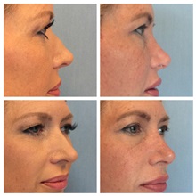 Rhinoplasty After Photo by Anthony Admire, MD; Scottsdale, AZ - Case 32596