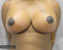 Breast Reduction After Photo by Daniel Kaufman, MD, FACS; New York, NY - Case 27867