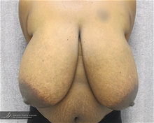 Breast Reduction Before Photo by Daniel Kaufman, MD, FACS; New York, NY - Case 27867