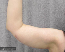 Arm Lift After Photo by Daniel Kaufman, MD, FACS; New York, NY - Case 27869