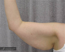 Arm Lift Before Photo by Daniel Kaufman, MD, FACS; New York, NY - Case 27869
