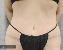 Tummy Tuck After Photo by Daniel Kaufman, MD, FACS; New York, NY - Case 27870