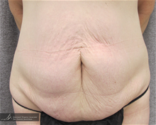 Tummy Tuck Before Photo by Daniel Kaufman, MD, FACS; New York, NY - Case 27870