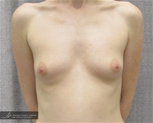 Breast Augmentation Before Photo by Daniel Kaufman, MD, FACS; New York, NY - Case 29461