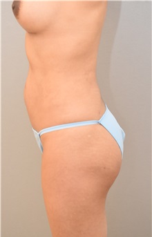 Buttock Lift with Augmentation After Photo by Keshav Magge, MD; Bethesda, MD - Case 31641