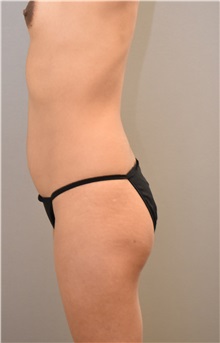 Buttock Lift with Augmentation Before Photo by Keshav Magge, MD; Bethesda, MD - Case 31641