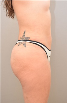 Buttock Lift with Augmentation After Photo by Keshav Magge, MD; Bethesda, MD - Case 31642