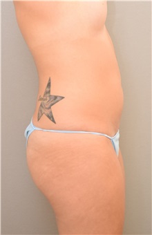 Buttock Lift with Augmentation Before Photo by Keshav Magge, MD; Bethesda, MD - Case 31642
