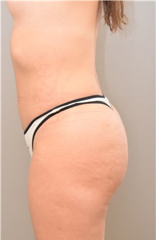 Buttock Lift with Augmentation After Photo by Keshav Magge, MD; Bethesda, MD - Case 31642