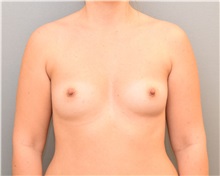 Breast Augmentation Before Photo by Keshav Magge, MD; Bethesda, MD - Case 31643