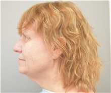 Facelift Before Photo by Keshav Magge, MD; Bethesda, MD - Case 31644