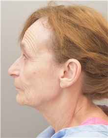 Facelift Before Photo by Keshav Magge, MD; Bethesda, MD - Case 31648
